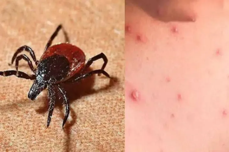 TN Health Department on high alert as scrub typhus cases rise